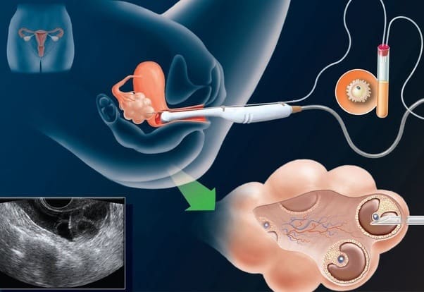 Cùng tìm hiểu quy trình thực hiện IVF tại Thái Lan chuẩn nhất hiện nay 4 Chọc hút trứng tại bệnh viện Thái Lan