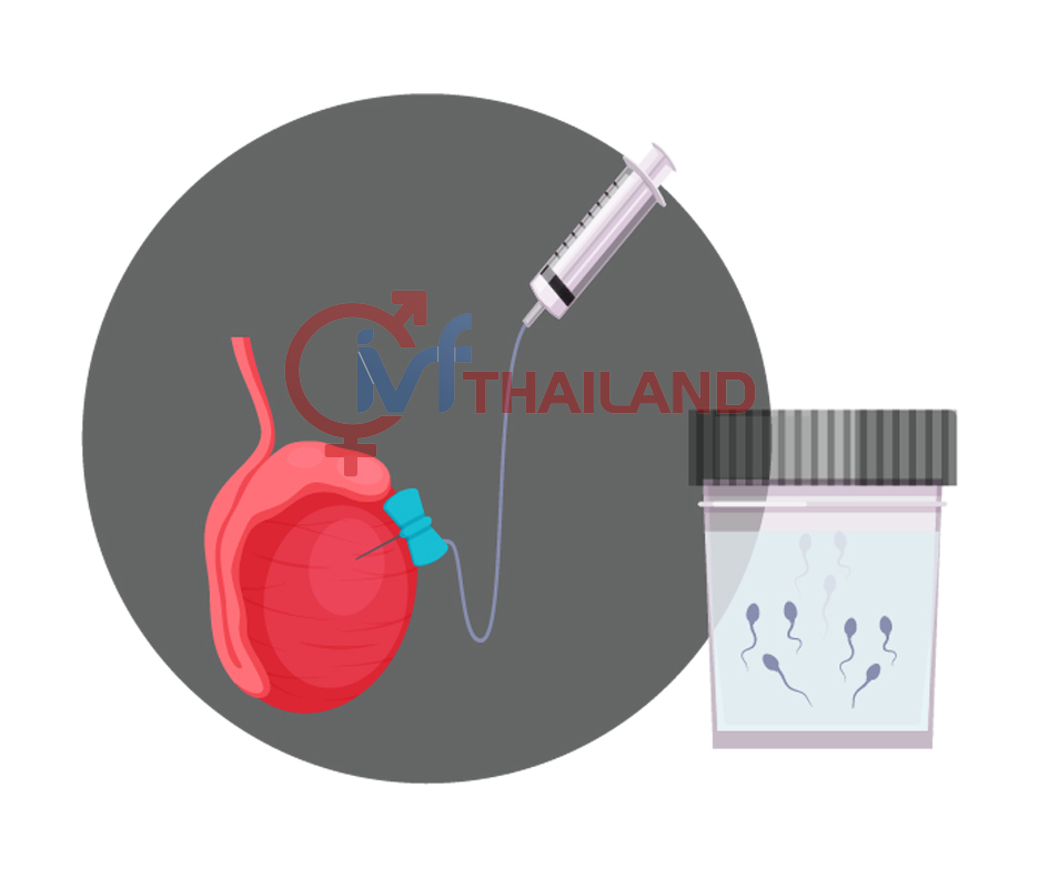 THU THẬP TẾ BÀO TINH TRÙNG TRỰC TIẾP TỪ TINH HOÀN (PESA / TESE) 1 THU-THAP-TE-BAO-TINH-TRUNG-TRUC-TIEP-TU-TINH-HOAN